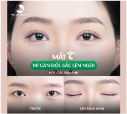 Mắt 1 mí khiến gương mặt chị em kém nổi bật