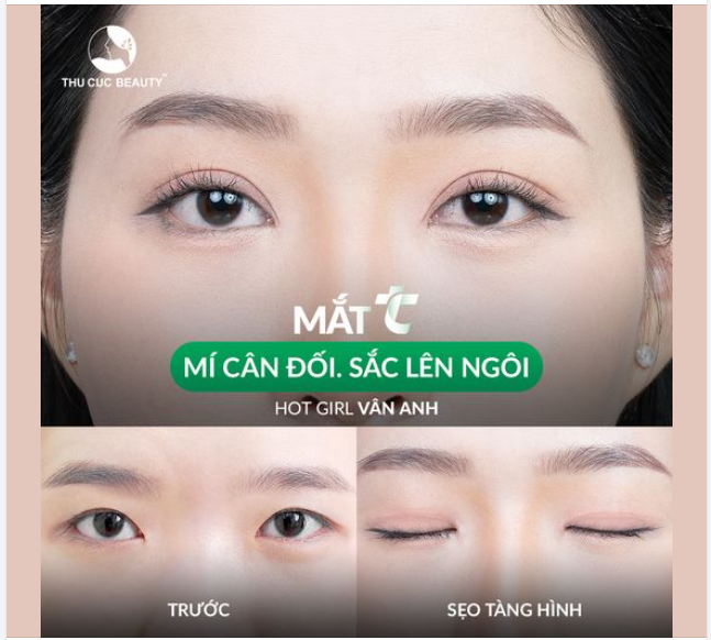 Mắt 1 mí khiến gương mặt chị em kém nổi bật