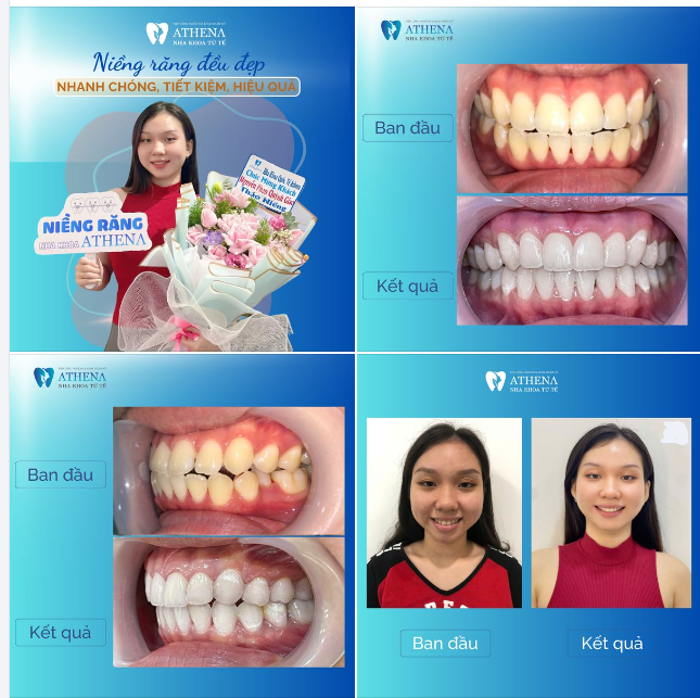 Niềng răng khấp khểnh an toàn- khởi đầu sự tự tin