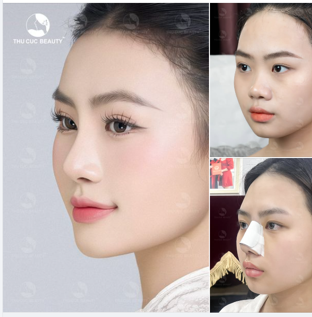 Dáng mũi hài hòa, cân đối độ cao vừa phải