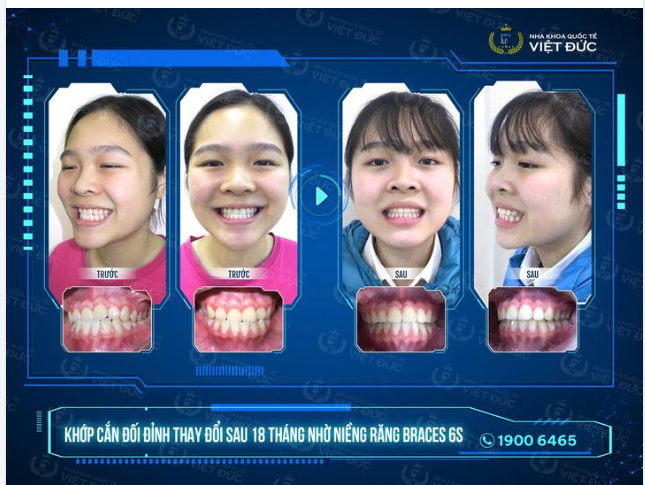 KHỚP CẮN ĐỐI ĐỈNH, NIỀNG RĂNG CÀNG SỚM, HIỆU QUẢ CÀNG CAO