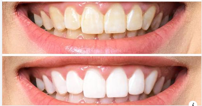 Cách làm trắng răng an toàn và hiệu quả là gì?