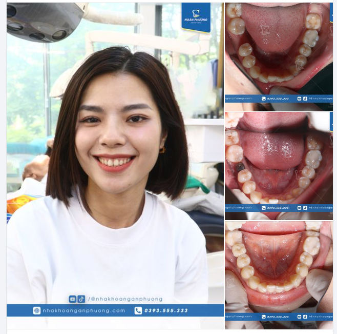 Cảm ơn chị Việt Hà đã tin tưởng phục hình implant tại Nha khoa Ngân Phượng