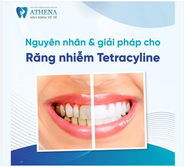 Có rất nhiều người bị nhiễm Tetracycline (hay còn gọi là răng bị nhiễm kháng sinh do tác dụng phụ của thuốc) khiến răng bị đổi màu nặng nề từ vàng đến xám.