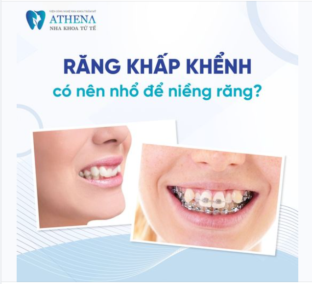 Răng khấp khểnh có nên nhổ khi niềng không?