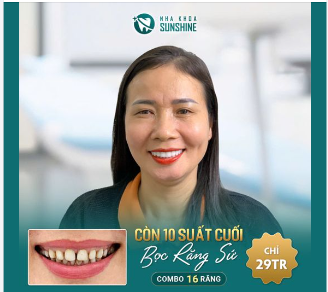 BỌC RĂNG SỨ CHỈ TỪ 29.000.000Đ/ 16 RĂNG TOÀN SỨ CAO CẤP
