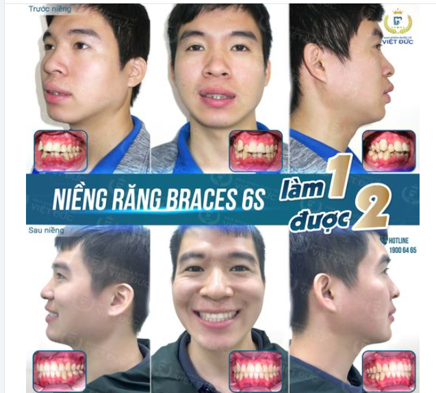 RĂNG HÔ, KHẤP KHỂNH, THAY ĐỔI SAU 2 NĂM NIỀNG RĂNG
