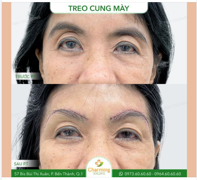 Trước khi thực hiện phẫu thuật treo cung mày, gương mặt của cô khách có dấu hiệu của sự lão hóa với cung mày bị chảy xệ, mí mắt trên bị sụp và vùng da quanh mắt có nếp nhăn khá rõ.