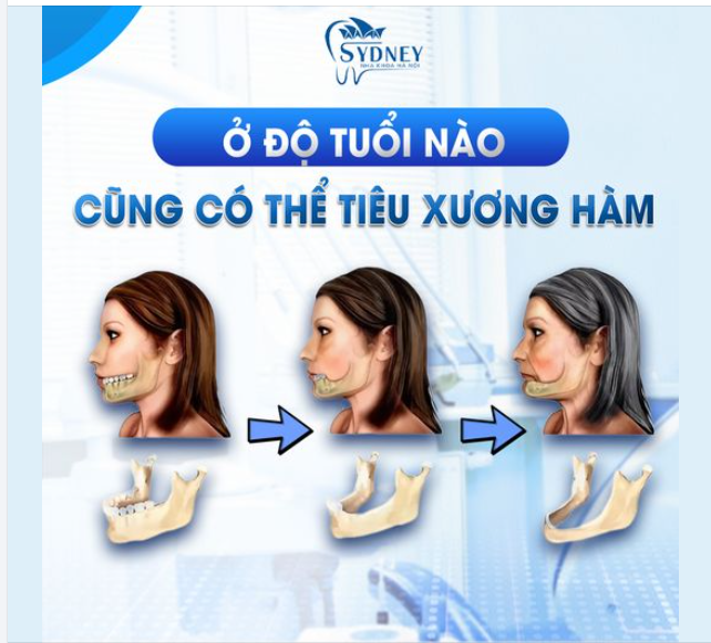 ĐỘ TUỔI NÀO CŨNG CÓ THỂ TIÊU XƯƠNG HÀM