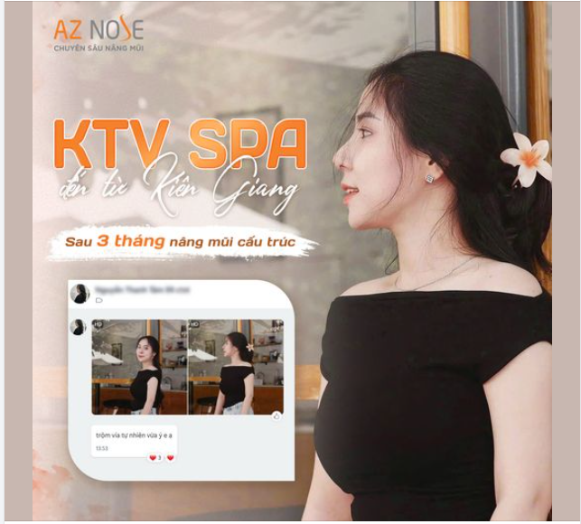 Vibe tựa "nàng thơ" của KTV Spa sau 3 tháng nâng mũi