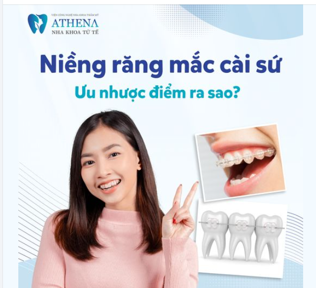 Niềng răng mắc cài sứ - Bí quyết cho nụ cười đẹp tự nhiên và thẩm mỹ cao