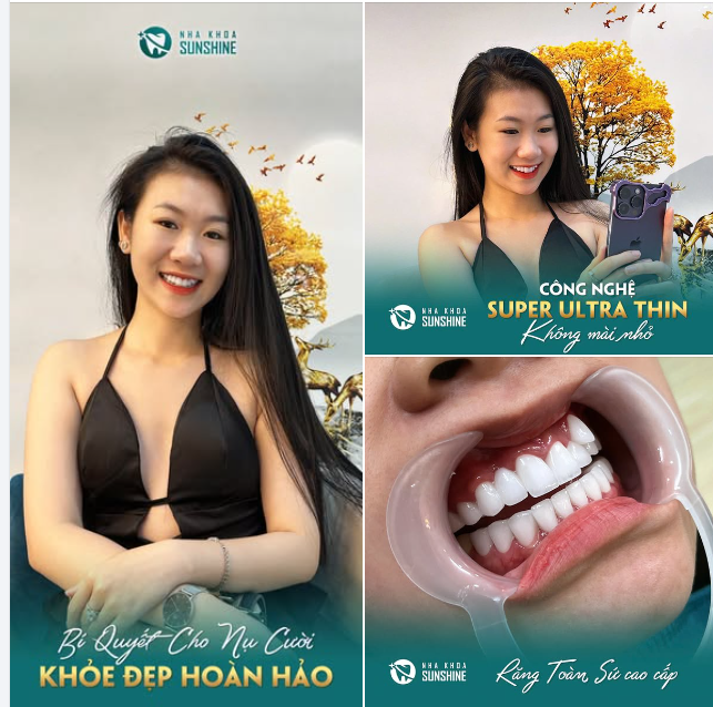 NÂNG TẦM NỤ CƯỜI VỚI BỌC RĂNG SỨ THẨM MỸ