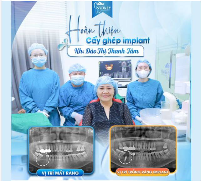 HOÀN THIỆN CẤY GHÉP IMPLANT CHO KH. THANH TÂM
