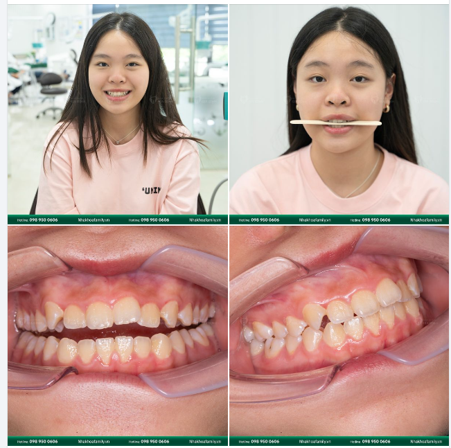 NIỀNG RĂNG NGAY VÌ MỘT HÀM RĂNG VỪA KHOẺ VỪA ĐẸP