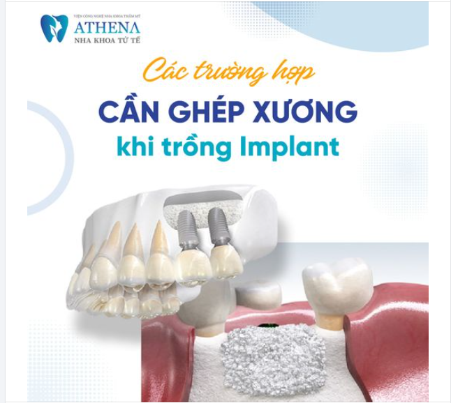Bạn có biết ? khi nào cần ghép xương khi nào cần trồng răng implant ?