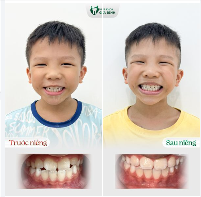 HÀNH TRÌNH THAY ĐỔI NỤ CƯỜI CHỈ SAU 3 THÁNG