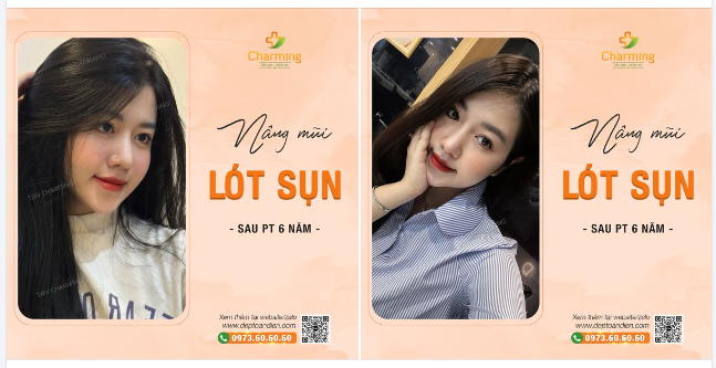 Nàng khách của Charming đã tâm sự rằng 6 năm trước nâng mũi lót sụn với Charming