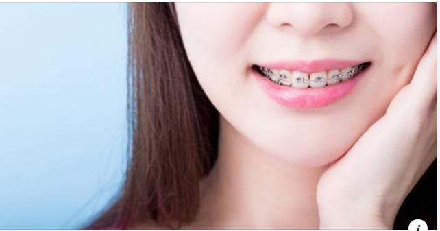 Chỉnh Nha – Đầu Tư Cho Sự Tự Tin Và Sức Khỏe Răng Miệng Lâu Dài!