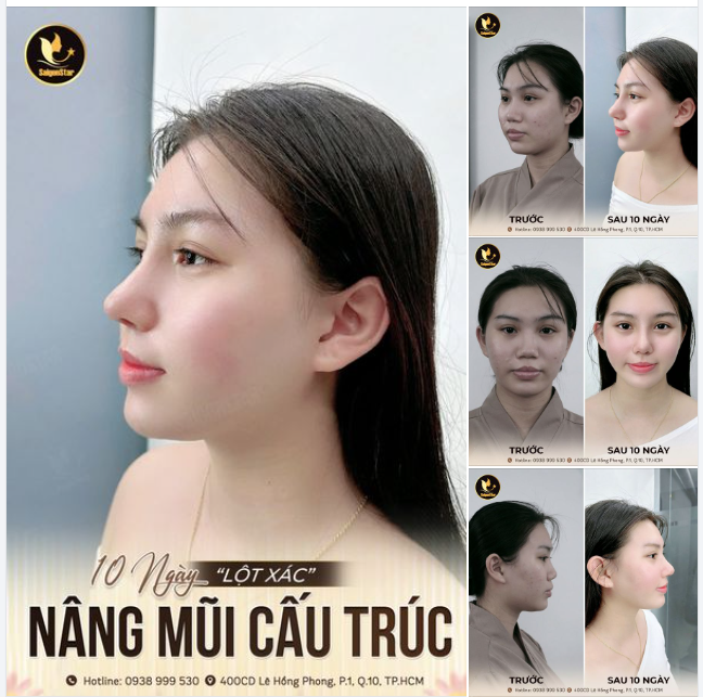 Thái Ngân hào hức chia sẻ sau khi được hỏi về dáng mũi mới.