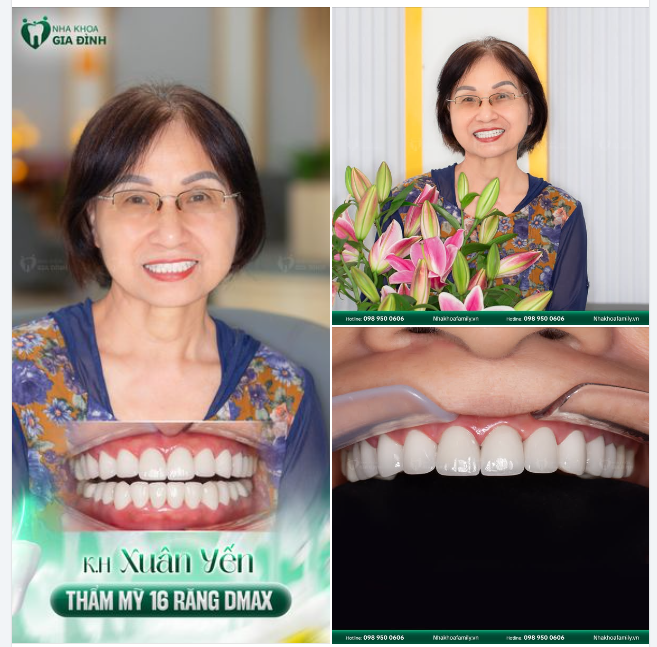 SỞ HỮU NỤ CƯỜI TỰ TIN CHỈ SAU HAI LẦN HẸN