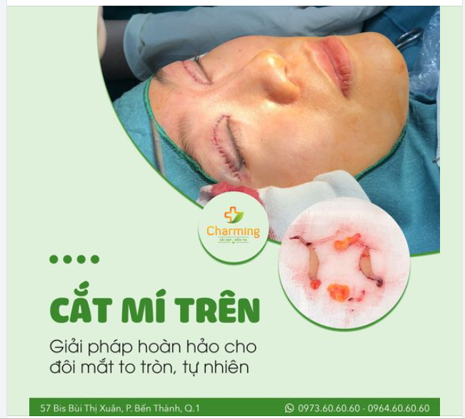 CẮT MÍ TRÊN – GIẢI PHÁP HOÀN HẢO CHO ĐÔI MẮT TO TRÒN, TỰ NHIÊN