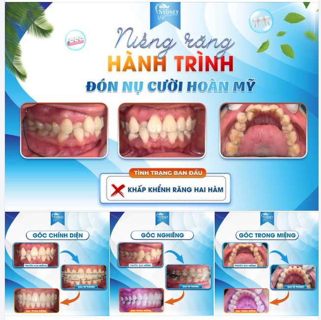NIỀNG RĂNG - HÀNH TRÌNH ĐÓN NỤ CƯỜI HOÀN MỸ