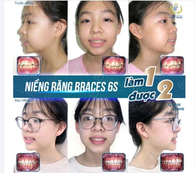 NIỀNG RĂNG CÀNG SỚM, HIỆU QUẢ CÀNG CAO  HẾT HÔ, KHẤP KHỂNH SAU 18 THÁNG