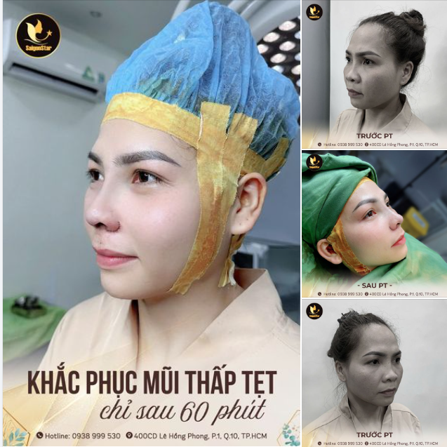 KẾT QUẢ TRƯỚC - SAU 60 PHÚT NÂNG MŨI CẤU TRÚC