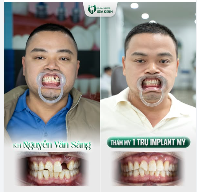 TRỒNG IMPLANT MAU ĐỂ MẤT RĂNG CỬA KHÔNG CÒN LÀ NỖI ĐAU