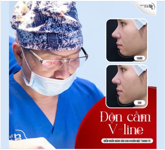 ĐỘN CẰM VLINE KHUÔN MẶT TĂNG VẺ THANH TÚ