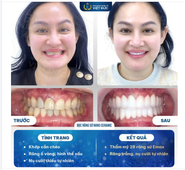 KHÁCH HÀNG THÁI LAN BẤT NGỜ SAU KHI LÀM RĂNG SỨ TẠI NKQT VIỆT ĐỨC