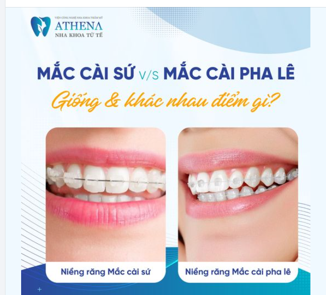 Mắc cài sứ và mắc cài pha lê– Bạn chọn loại nào để niềng răng?