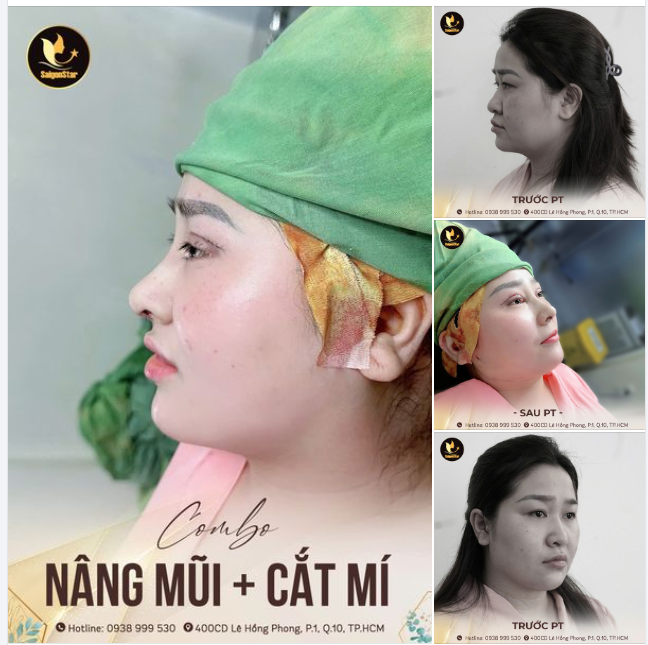 NÂNG MŨI + CẮT MÍ CHUẨN COMBO LỘT XÁC TOÀN DIỆN