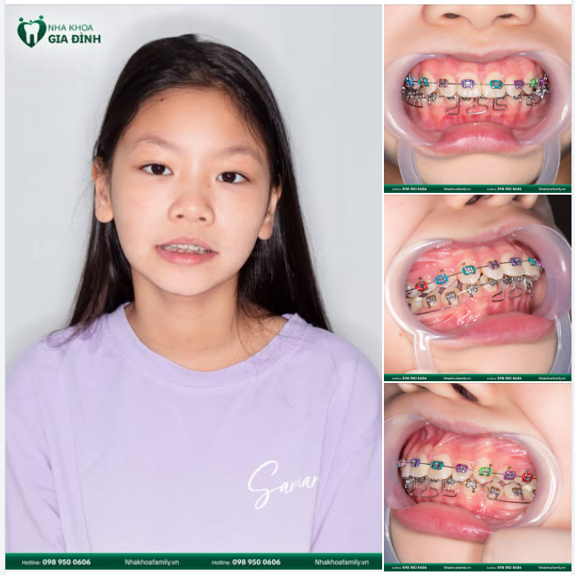 NIỀNG RĂNG LÀ HÀNH TRÌNH TÌM TỚI CÁI ĐẸP