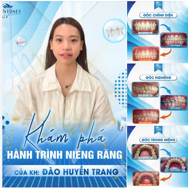 KHÁM PHÁ HÀNH TRÌNH NIỀNG RĂNG CỦA KH H.TRANG