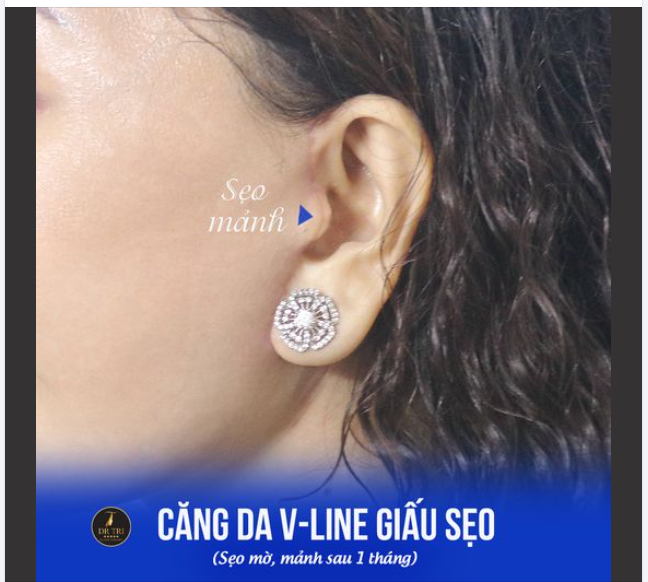 Chiều ý mấy chị đẹp muốn "xem cận cảnh HD tràn viền" đường sẹo Căng da VLine​​​​​​​ sau 1 tháng