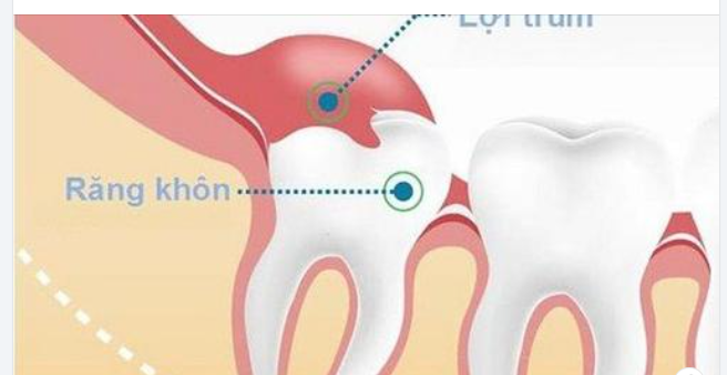Lợi trùm răng khôn: Dấu hiệu nhận biết và cách xử trí