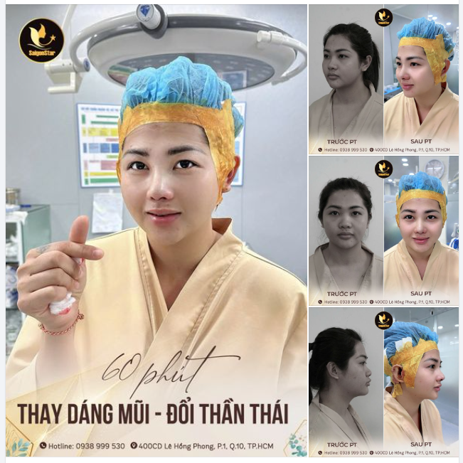 MŨI ĐẸP MẶT SANG CHO NÀNG TỎA SÁNG