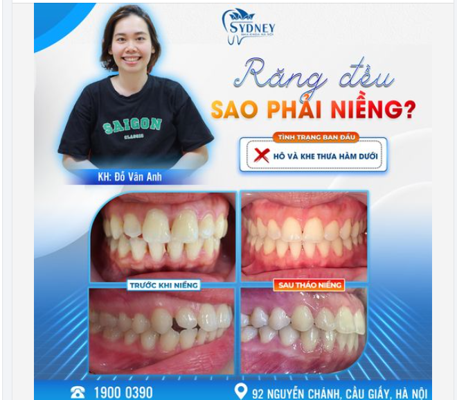 RĂNG ĐỀU RỒI SAO PHẢI NIỀNG?