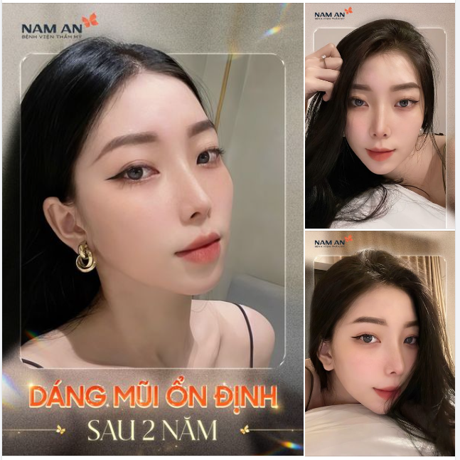 DÁNG MŨI ỔN ĐỊNH – HOÀN HẢO ĐẾN TỪNG GÓC NHÌN