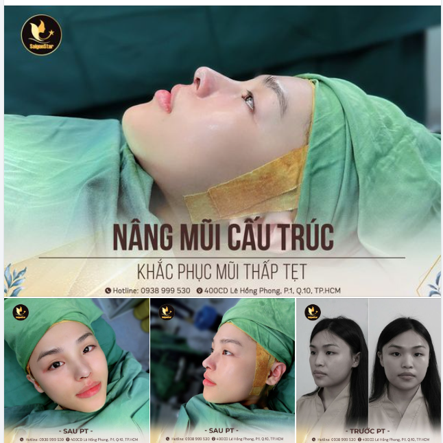 CẬN CẢNH DÁNG MŨI CẤU TRÚC SAU 60 PHÚT THỰC HIỆN
