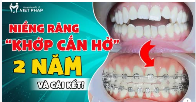NIỀNG RĂNG “KHỚP CẮN HỞ” 2 NĂM VÀ CÁI KẾT…
