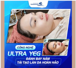 CÔNG NGHỆ ULTRA YEG ĐÁNH BAY NÁM