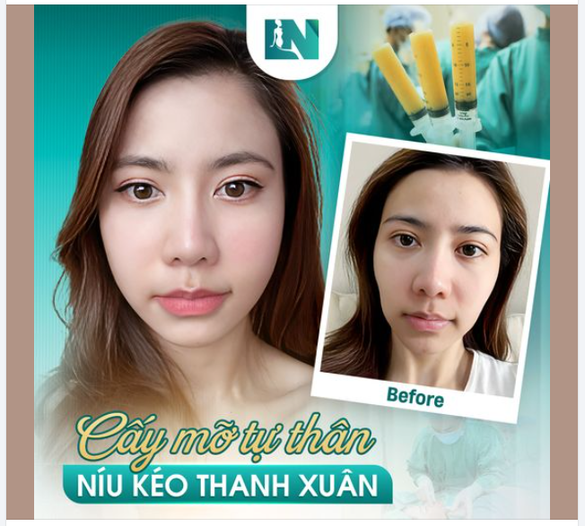 CẤY MỠ LÀM ĐẦY KHUÔN MẶT
