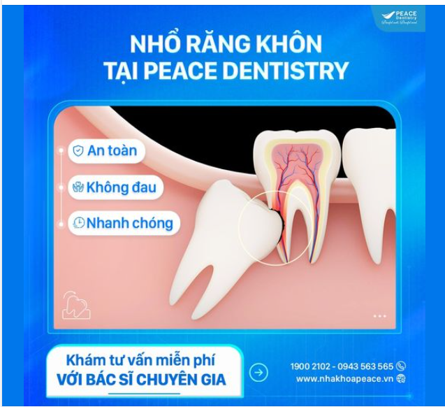 XỬ LÝ RĂNG KHÔN NGAY TRƯỚC KHI QUÁ MUỘN
