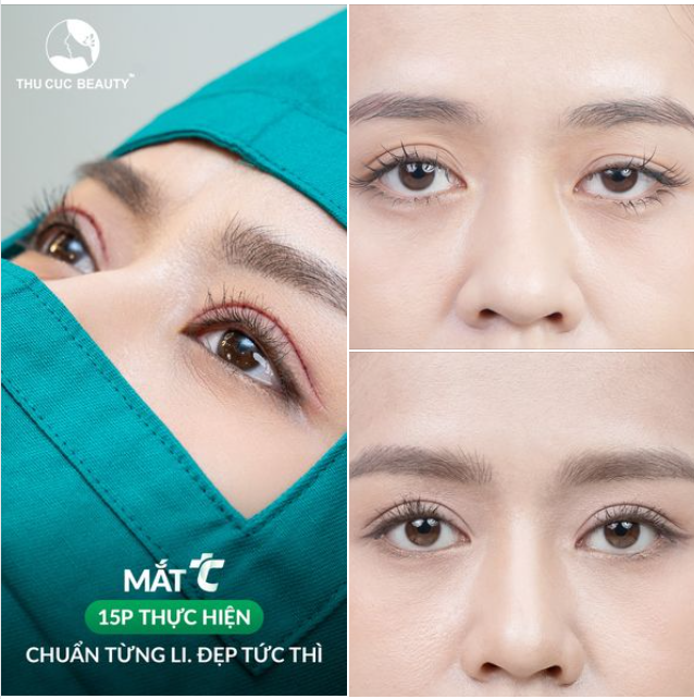 Cắt mí GIẢM 35%. Đẹp an toàn với chi phí siêu tiết kiệm