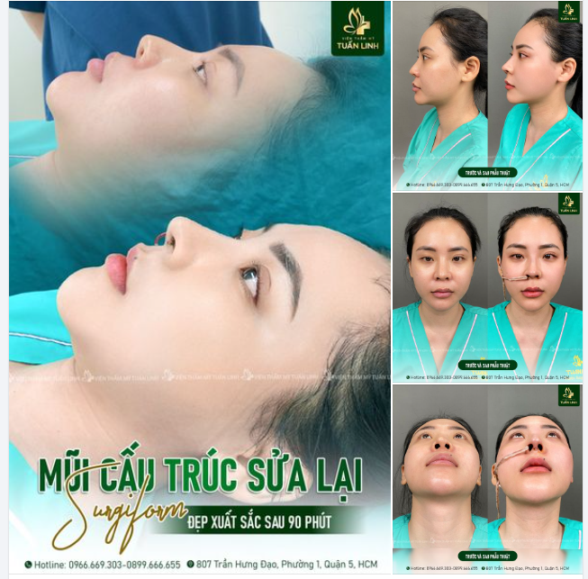 MŨI CẤU TRÚC SỬA LẠI SỤN SURGIFORM NHẸ NHÀNG - THANH THOÁT - TỰ NHIÊN - ĐẸP SẮC NÉT!!