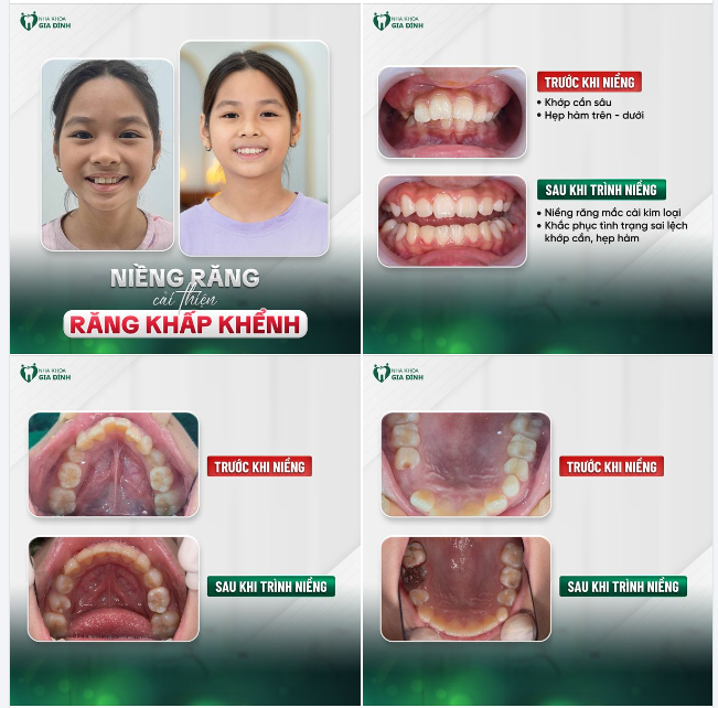 Hành Trình Thay Đổi Nụ Cười Chỉ Trong 9 Tháng