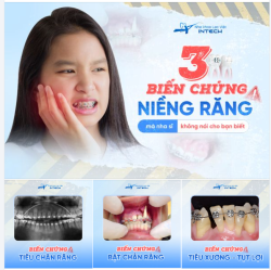 3 BIẾN CHỨNG NGUY HIỂM KHI NIỀNG RĂNG SAI CÁCH!