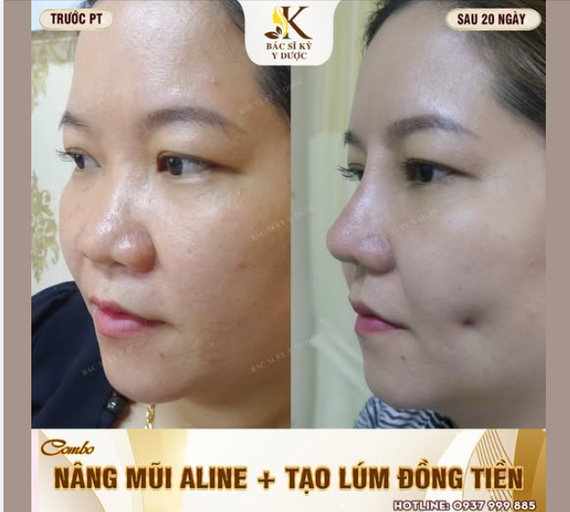 TỎA SÁNG VỚI NHAN SẮC ĐỈNH CAO: COMBO NÂNG MŨI + TẠO MÁ LÚM ĐỒNG TIỀN